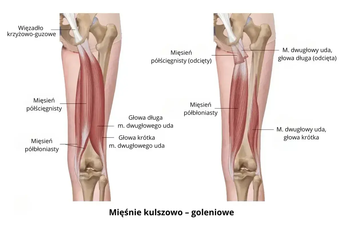 Anatomia mięśni kulszowo-goleniowych. Ilustracja pokazuje mięsień dwugłowy uda, jego głowy długą i krótką. Zapalenie mięśnia czworogłowego uda objawy mogą być podobne.