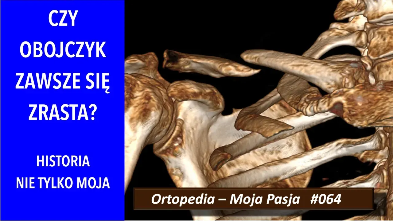Trójwymiarowy obraz RTG ukazujący złamanie obojczyka. Czy obojczyk zawsze się zrasta? Historia nie tylko moja.