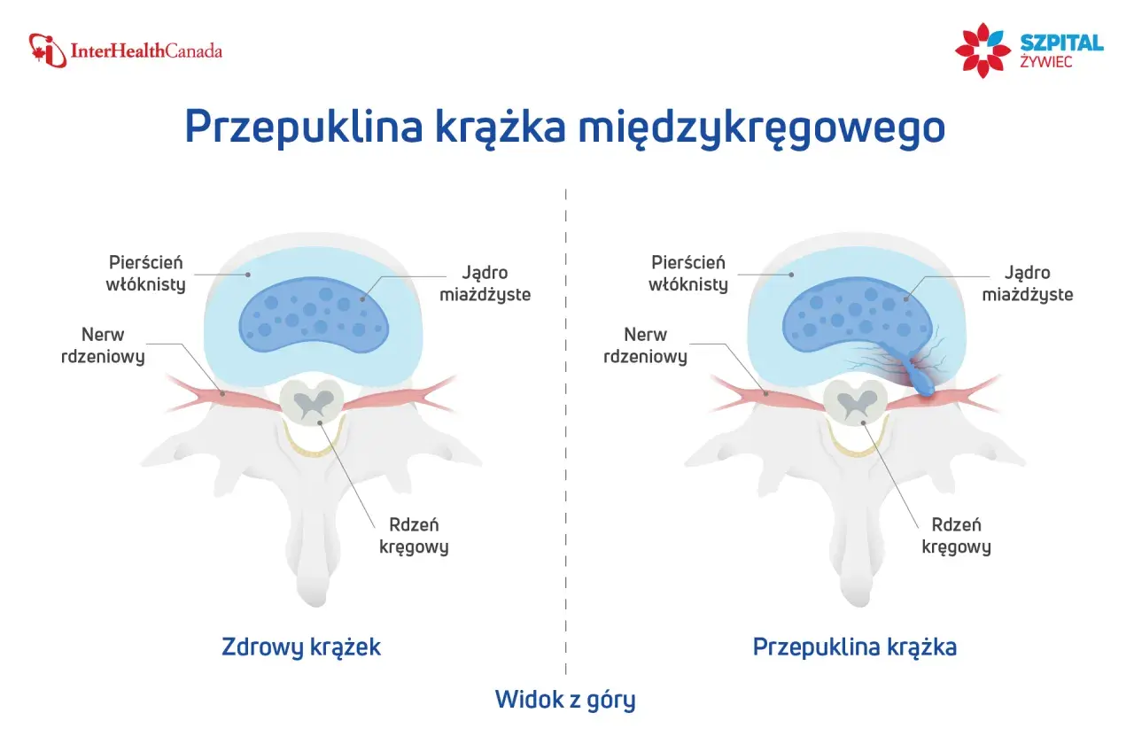 Ilustracja pokazuje zdrowy krążek międzykręgowy i przepuklinę krążka, wyjaśniając, jak leczyć przepuklinę.