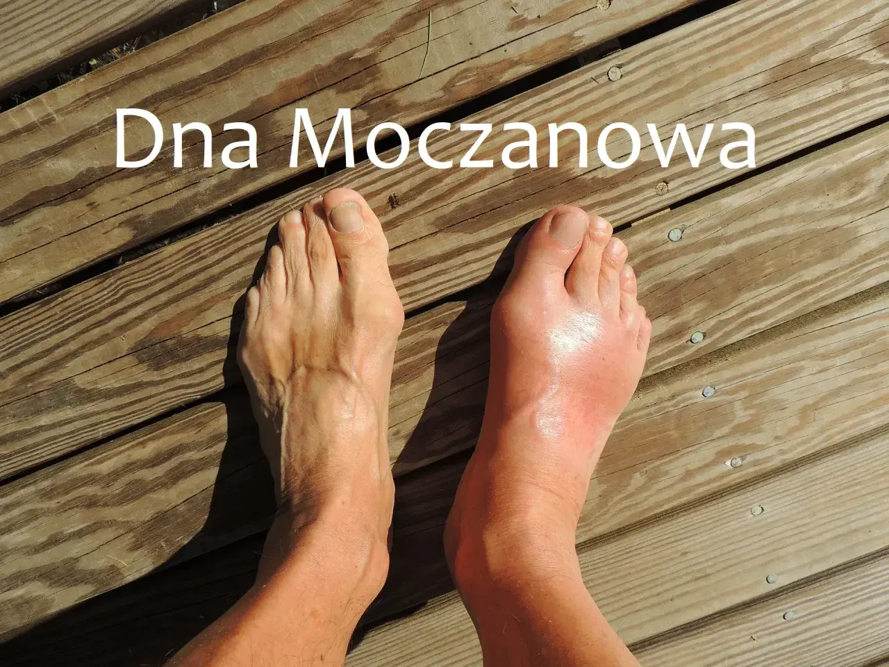 Dna moczanowa powoduje ból śródstopia. Prawa stopa jest zaczerwieniona i spuchnięta, lewa wygląda zdrowo.