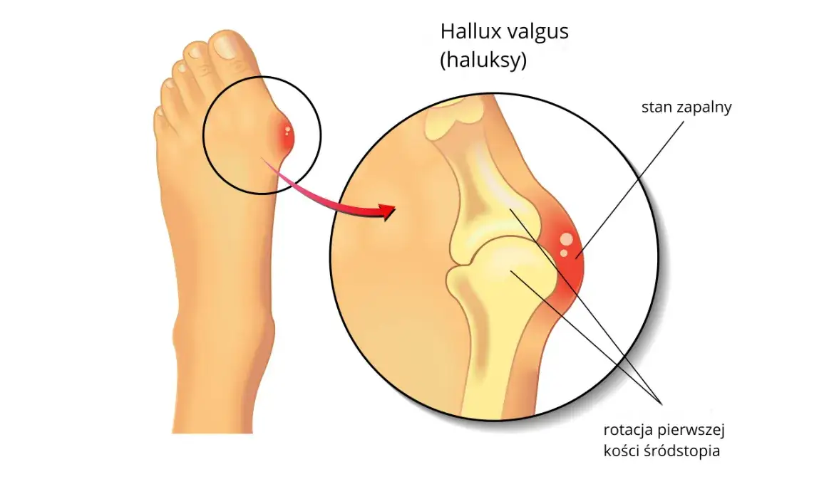anatomia stopy haluks ból schemat