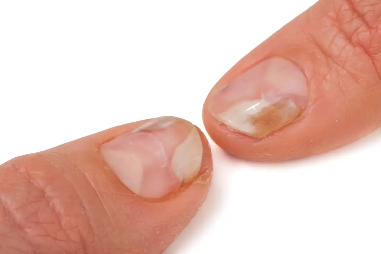 Wizyta u dermatologa grzybica paznokci