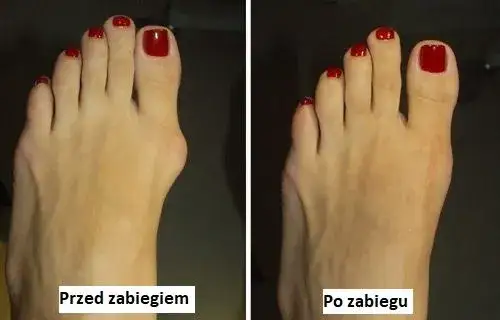 Koszt operacji haluksa prywatnie