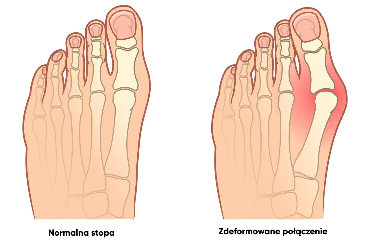 porównanie stopy zdrowej i stopy z zaawansowanym haluksem