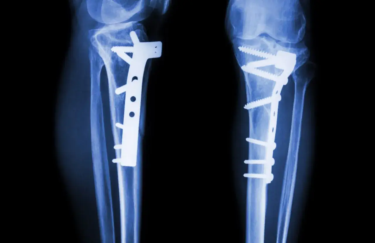 RTG obu piszczeli po osteotomii. Widoczne zespolenia płytami i śrubami stabilizują kości.