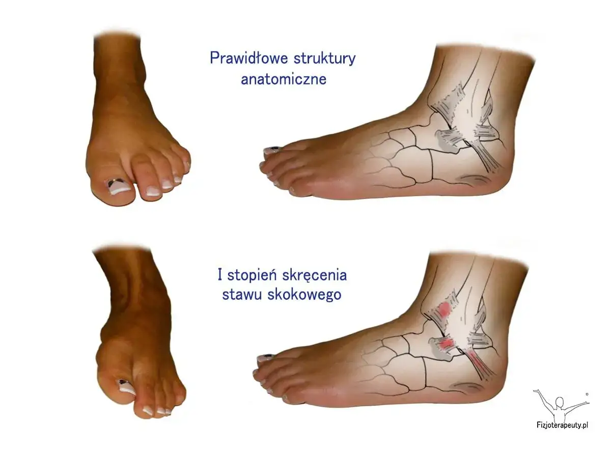 Porównanie prawidłowej anatomii stawu skokowego z I stopniem skręcenia, ukazujące zwichnięta kostka objawy.