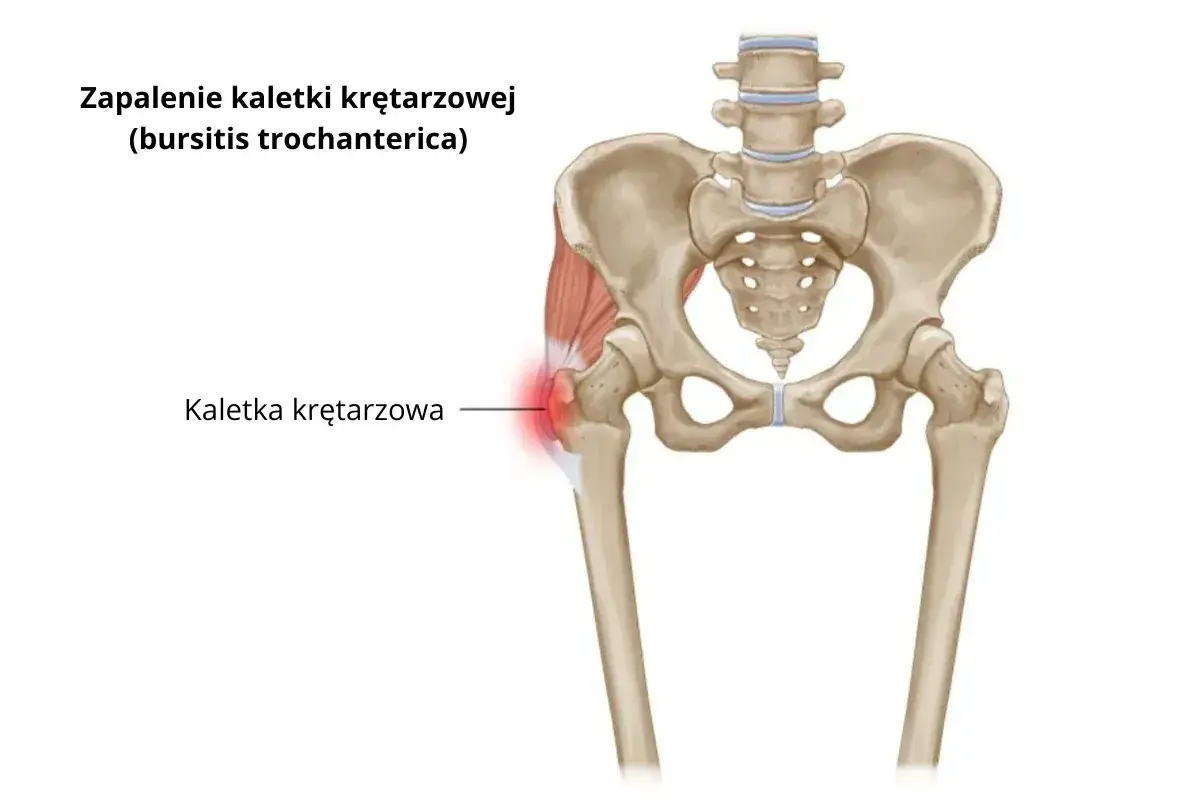zastrzyk w biodro kaletka krętarzowa