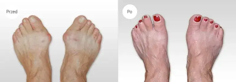 porównanie stopy z haluksem przed i po operacji, schemat korekcji haluksa