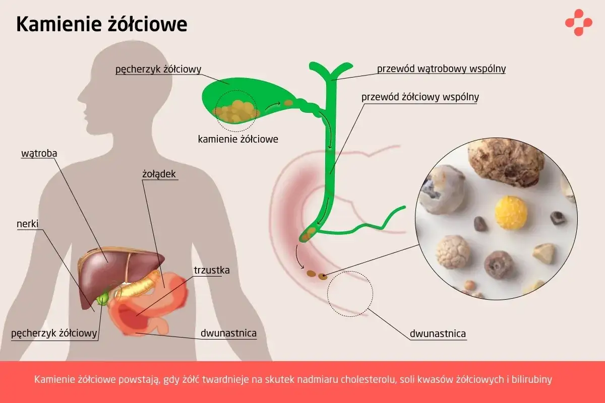 leczenie kamicy żółciowej schemat