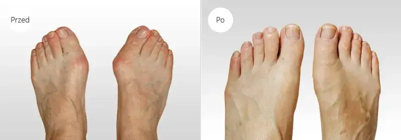 techniki operacji haluksa porównanie