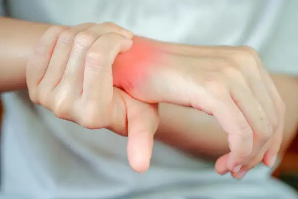 Dłoń z zaczerwienionym, bolącym nadgarstkiem, pokazująca jak wygląda złamana ręka bez gipsu.