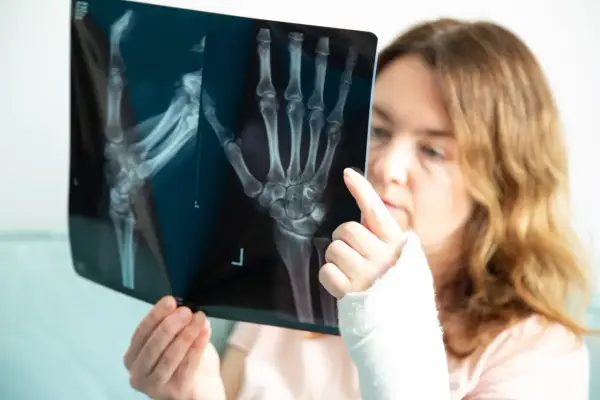 Kobieta z ręką w gipsie analizuje zdjęcie RTG, na którym widoczne jest złamanie spiralne kości.