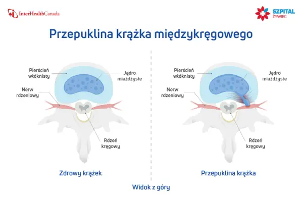 Ilustracja pokazuje zdrowy krążek międzykręgowy i przepuklinę krążka, wyjaśniając, jak leczyć przepuklinę.